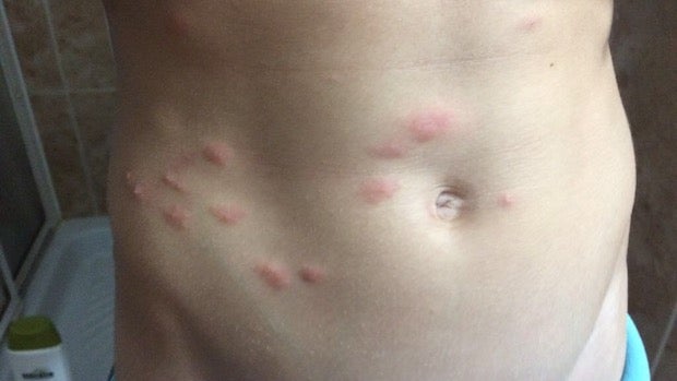 Dos niños acaban en urgencias en Vélez-Málaga por picaduras de pulgas en el colegio Dos niños acaban en urgencias en Vélez-Málaga por picaduras de pulgas en el colegio