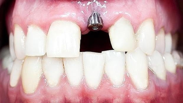 Implante dental