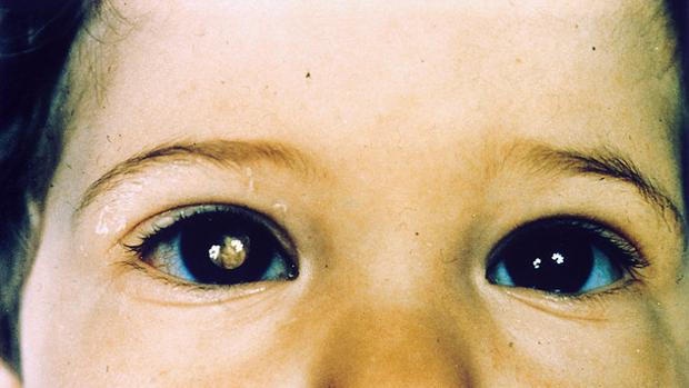 Cáncer de retina